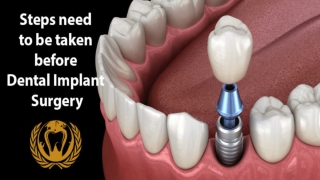 Steps before dental implant surgery