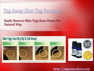 Tag Away Proving to be the Best Home Remedy for Skin Tags
