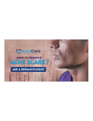 How To Remove Acne Scars? Ask A Dermatologist