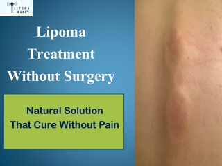 Discover a New Solution for Lipoma Treatment at Home