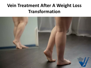 Vein Treatment After A Weight Loss Transformation