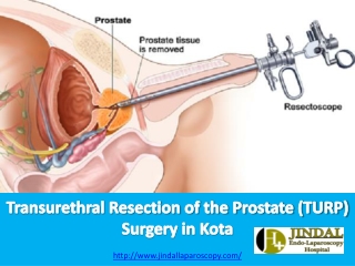 Transurethral Resection of the Prostate (TURP) Surgery in Kota