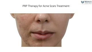 PRP Therapy for Acne Scars Treatment