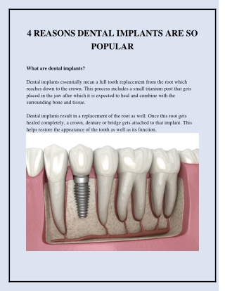 4 REASONS DENTAL IMPLANTS ARE SO POPULAR