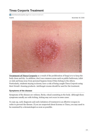 Tinea Corporis Treatment