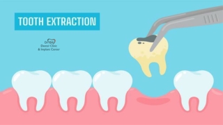 IS SMOKING AFTER TOOTH EXTRACTION SAFE?