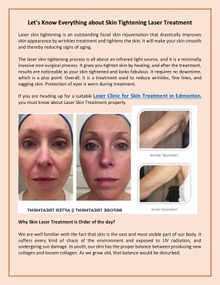 Let's Know Everything about Skin Tightening Laser Treatment