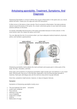 Ankylosing spondylitis: Treatment, Symptoms, And Diagnosis 