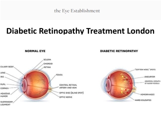 Diabetic Retinopathy Treatment London