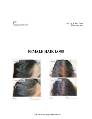 Female Hair Loss Treatment
