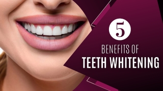 5 Benefits of Teeth Whitening