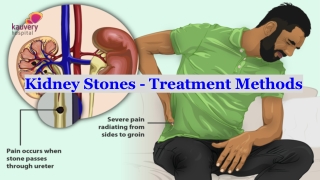 Kidney Stones - Treatment Methods