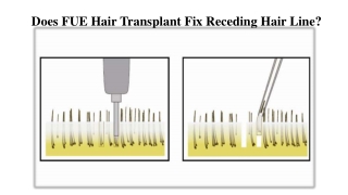 Does FUE Hair Transplant Fix Receding Hair Line?