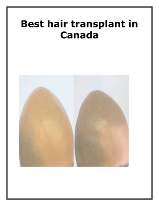 Best hair transplant in Canada