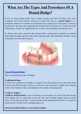 What Are The Types And Procedures Of A Dental Bridge?