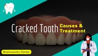 Cracked Tooth Causes and Treatment by Brampton Dentist