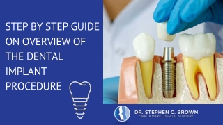 Step by step guide on overview of the dental implant procedure