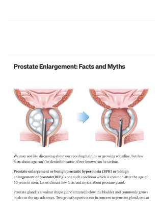 Prostate Enlargement Facts and Myths