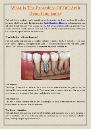 What Is The Procedure Of Full Arch Dental Implants?