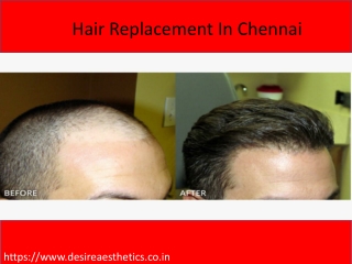 Hair Replacement In Chennai