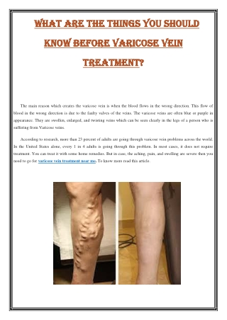 What are the things you should know before varicose vein treatment?