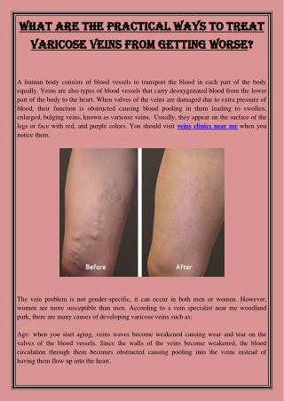 What are The Practical Ways To Treat Varicose Veins From Getting Worse?