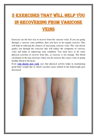 5 Exercises that will help you in recovering from varicose veins