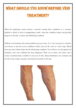 What should you know before Vein Treatment