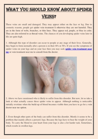 What you should know about Spider veins