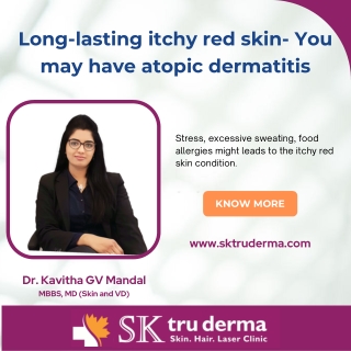 Atopic dermatitis | Dermatologist in sarjapur road |  SKTruderma | Dr.Kavitha GV