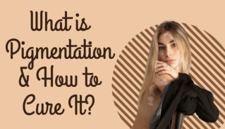What is (रंजकता) Pigmentation and How to Cure It?