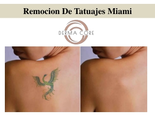 Remocion De Tatuajes Miami