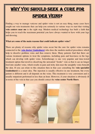 Why You Should Seek a Cure For Spider Veins