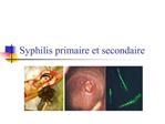 Syphilis primaire et secondaire