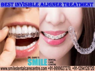 Best Invisible Aligner Treatment and Braces in Faridabad