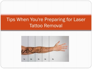 Tips When You're Preparing for Laser Tattoo Removal