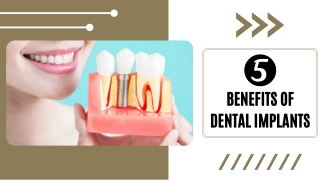 5 Benefits of Dental Implants