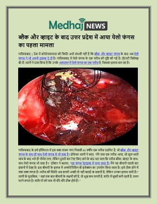 ब्लैक और व्हाइट के बाद उत्तर प्रदेश में आया येलो फंगस का पहला मामला