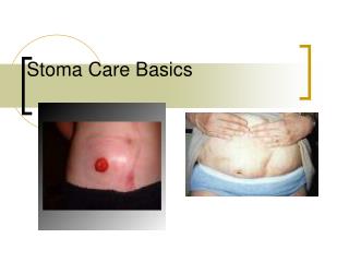 Stoma Care Basics