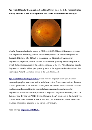 Age-related Macular Degeneration - pdf