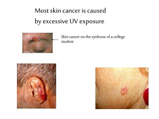 Most skin cancer is caused by excessive UV exposure