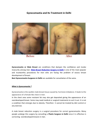 Gynecomastia and Its Treatment in Delhi