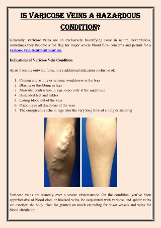 Is Varicose Veins a Hazardous Condition