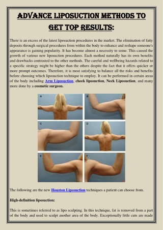 Advance Liposuction Methods To Get Top Results