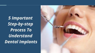 5 Important Step-by-step Process To Understand Dental Implants