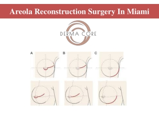 Areola Reconstruction Surgery In Miami