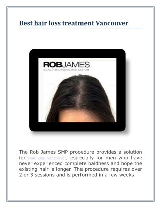 Best hair loss treatment Vancouver