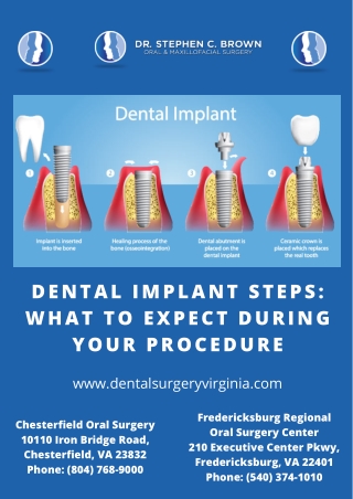 Dental Implant Steps What To Expect During Your Procedure