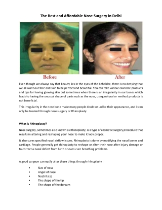 The Best and Affordable Nose Surgery in Delhi