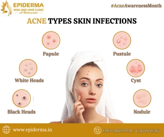 Acne Types | Best Acne Treatment in Jayanagar, Bangalore | Epiderma Clinic